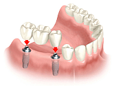 Implantarea dinţilor