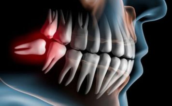 И всё-таки, сколько должно быть зубов у здорового человека? snimok chelyusti 2