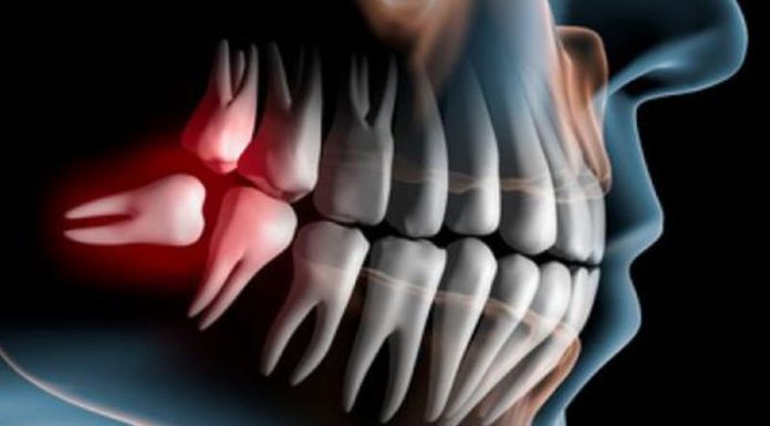 И всё-таки, сколько должно быть зубов у здорового человека? snimok chelyusti 2
