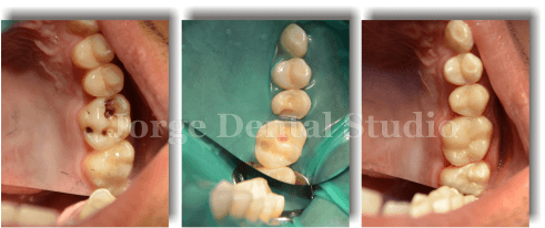 Лечение глубокого кариеса коренных зубов