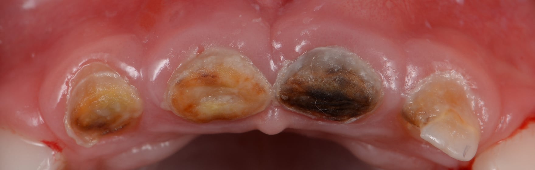Лечение ребенка под общим наркозом с применением микроскопа