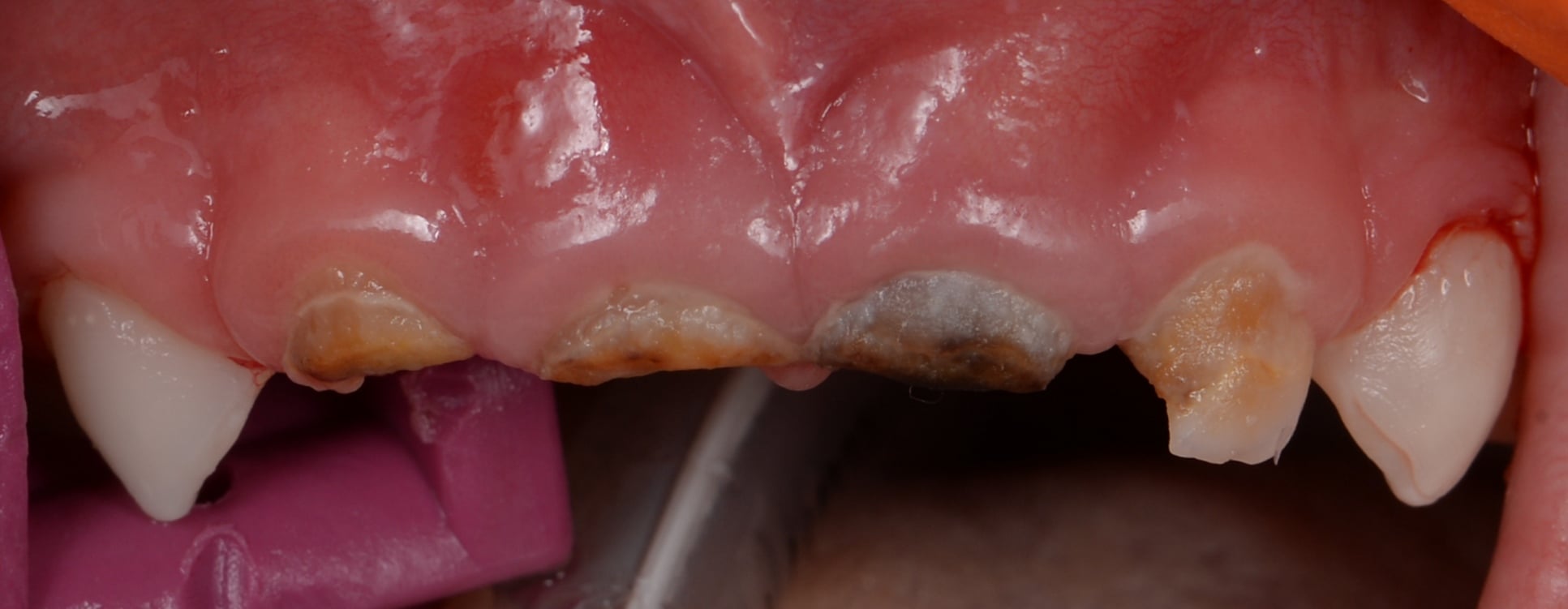 Лечение ребенка под общим наркозом с применением микроскопа